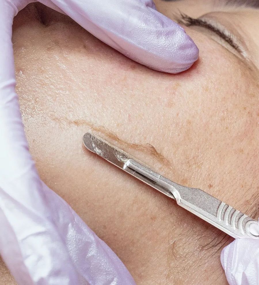 Dermaplaning