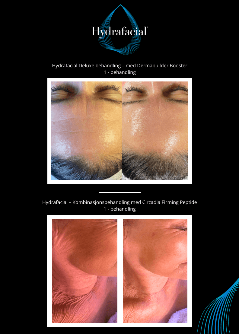 Bilde av Hydrafacial Deluxe behandling for glødende hud.