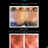 Bilde av Hydrafacial Deluxe behandling for glødende hud.