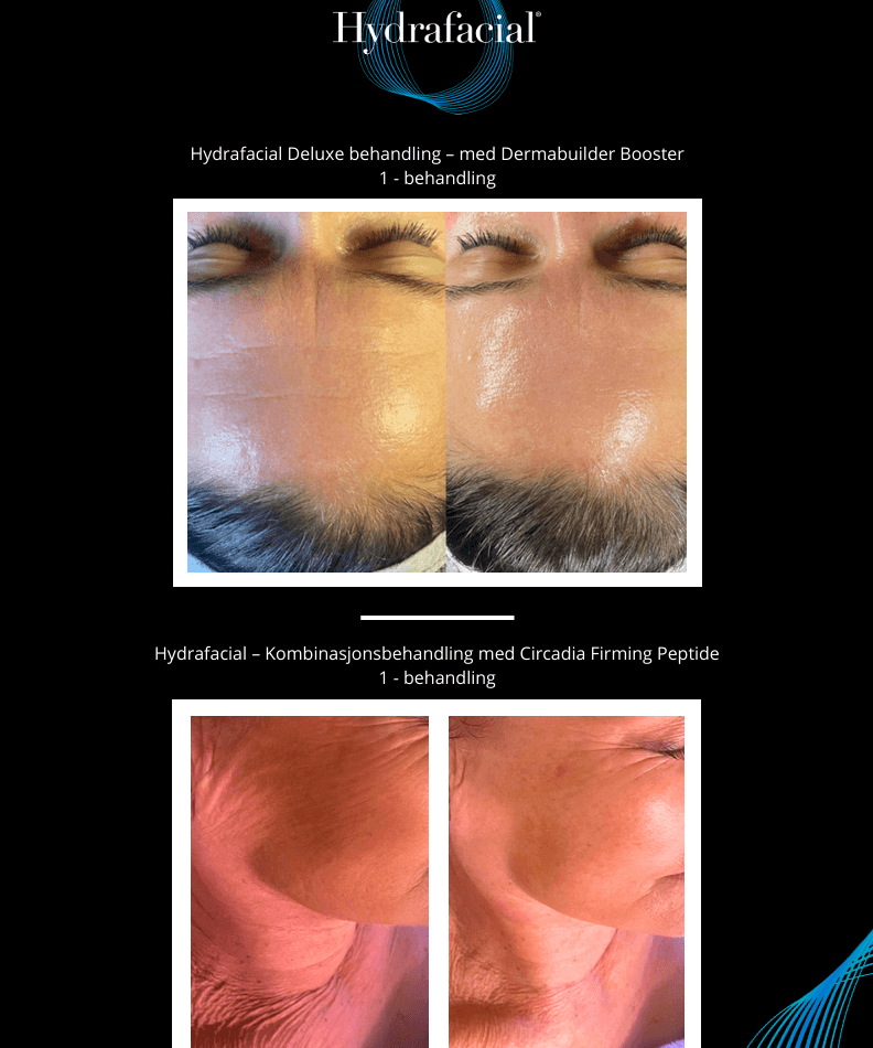 Bilde av Hydrafacial Deluxe behandling for glødende hud.
