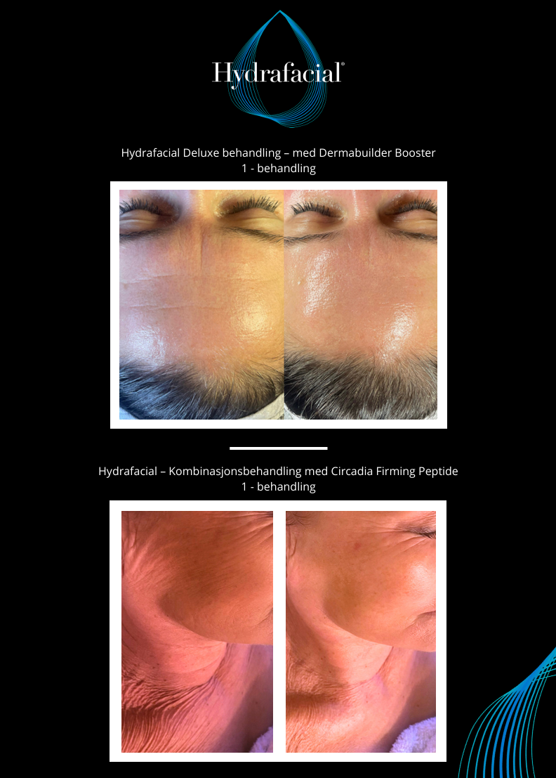 Hydrafacial Signaturpakke 2 Full Beauty Glow