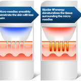 RF Microneedling – Radiofrekvens