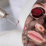Laser Karbon Peeling - Sacha Hudpleie