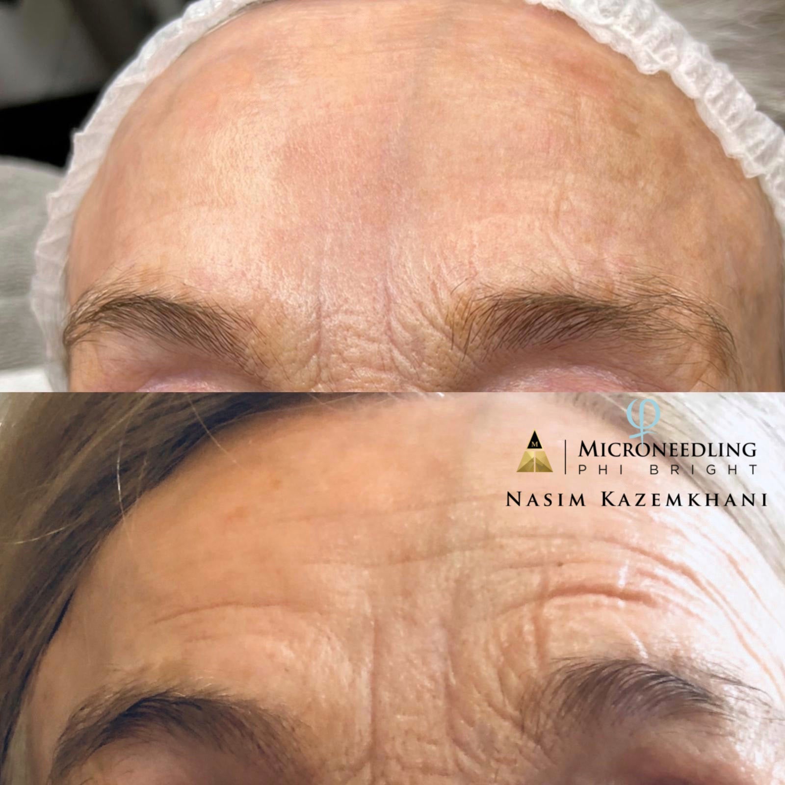 MICRONEEDLING WITH WORKSHOP - Sacha Hudpleie