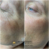 MICRONEEDLING WITH WORKSHOP - Sacha Hudpleie