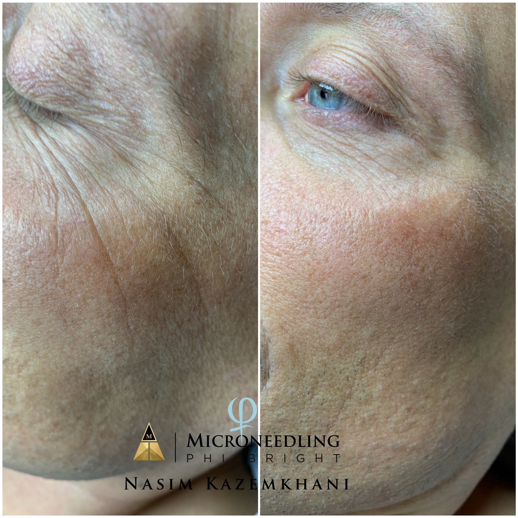 MICRONEEDLING WITH WORKSHOP - Sacha Hudpleie