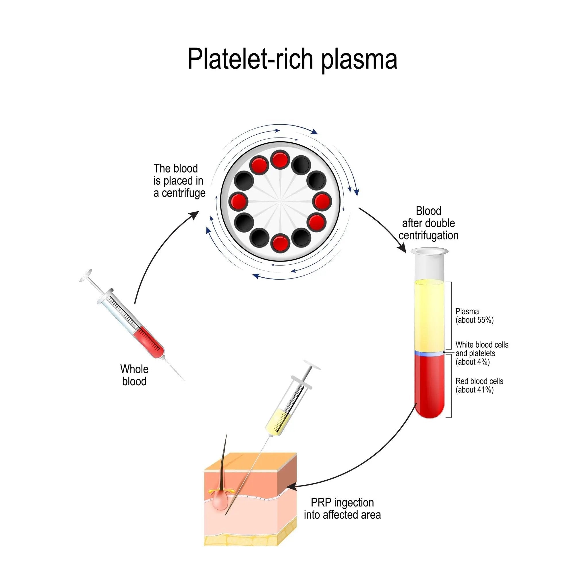 PRP: Ansikt m/ microneedling - Sacha Hudpleie